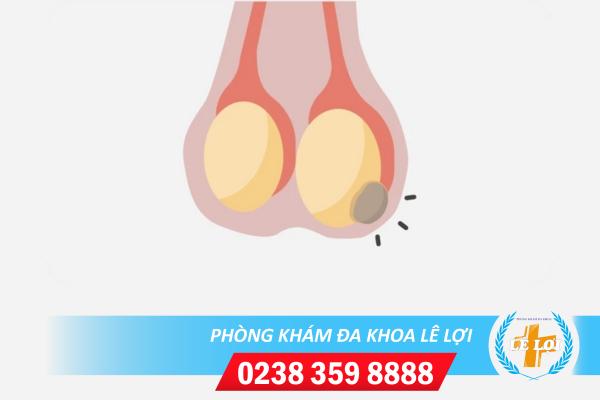 Tinh hoàn nổi cục là bị bệnh gì?