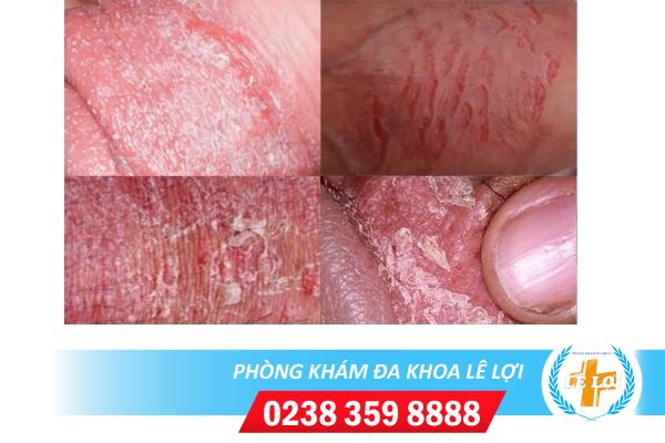Tróc da quy đầu phải làm sao để chữa trị?