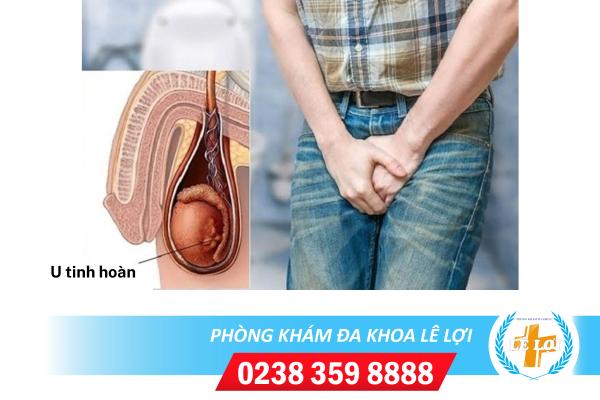 U tinh hoàn – Căn bệnh mà nam giới cần phải đề phòng
