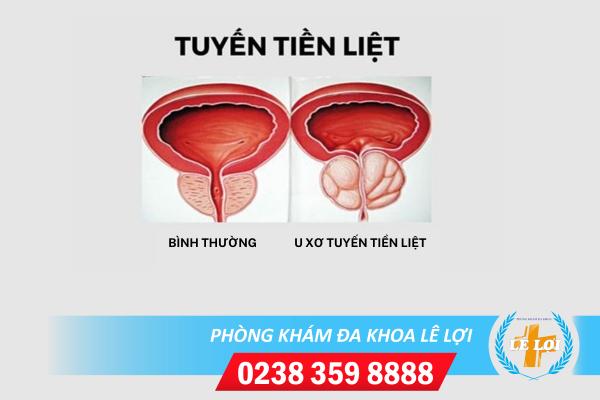 Bệnh u xơ tuyến tiền liệt ở nam giới và những kiến thức cần biết