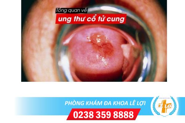 ung-thu-co-tu-cung-dau-hieu
