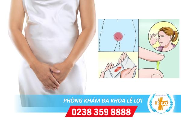 Bệnh viêm âm đạo gây nhiều phiền toái đối với sinh hoạt của chị em