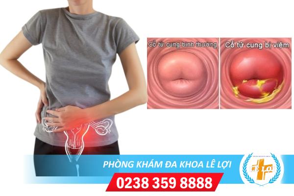 Những Tác Hại Của Bệnh Viêm Cổ Tử Cung Và Cách Điều Trị