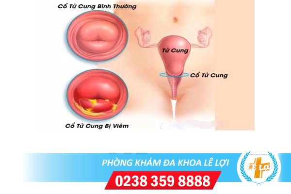 Những Biểu Hiện Nguy Hiểm Của Bệnh Viêm Cổ Tử Cung