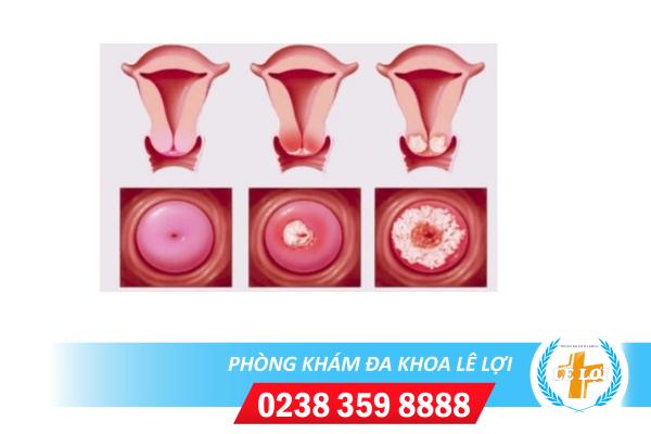 Bạn biết gì về bệnh viêm lộ tuyến cổ tử cung?