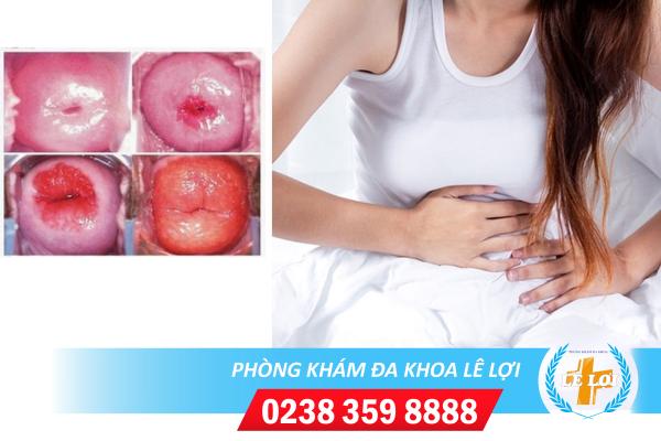 Nguyên nhân viêm loét tử cung và cách điều trị