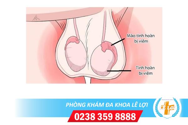 Hỗ trợ điều trị viêm mào tinh hoàn như thế nào hiệu quả?