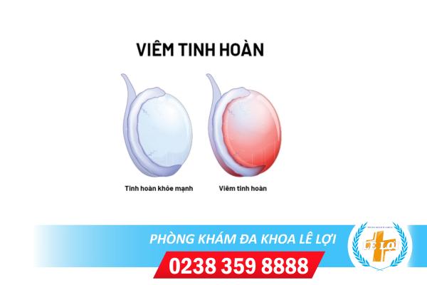 Viêm tinh hoàn – căn bệnh gây hại với sức khỏe sinh sản