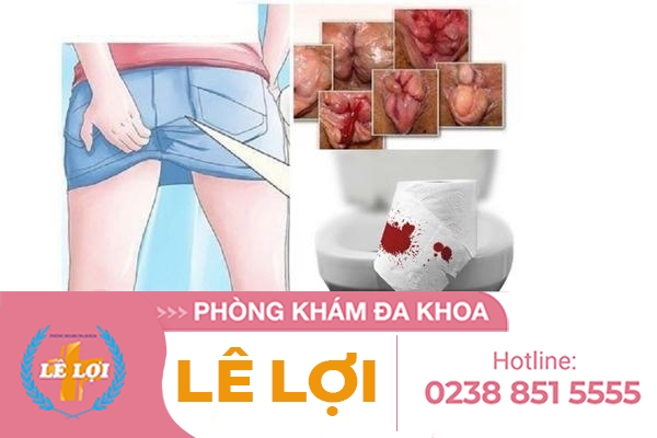 Bệnh lòi dom là gì? Nguyên nhân, triệu chứng và cách điều trị