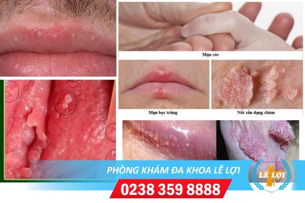 Những phương pháp xét nghiệm HPV hiện nay