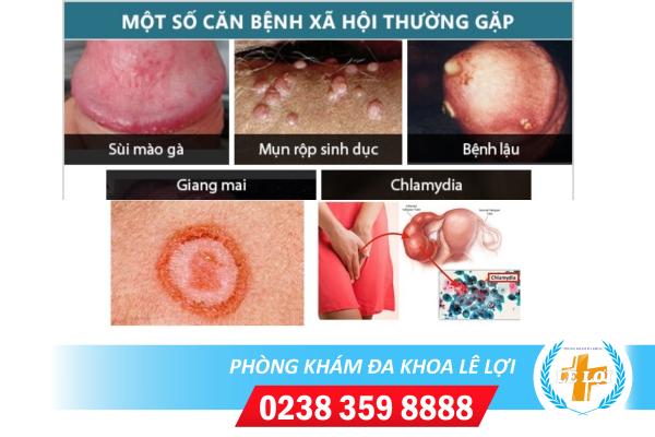 benh-xa-hoi-hay-gap-hien-nay