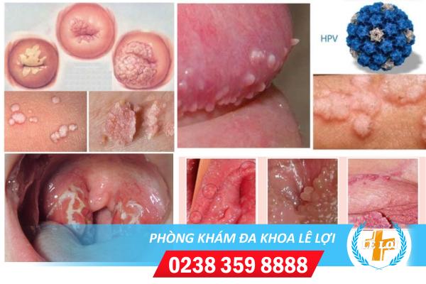 dau-hieu-nhan-biet-benh-hpv-la-gi