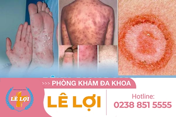 giang-mai-dau-hieu-hay-gap