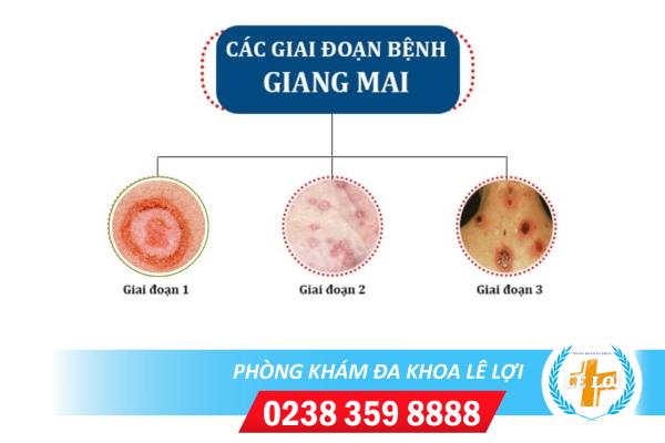 Địa chỉ chữa giang mai uy tín hiện nay