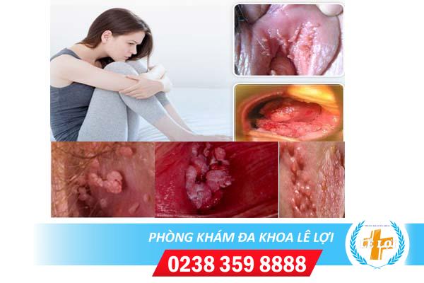 Bệnh sùi mào gà có chữa được không?