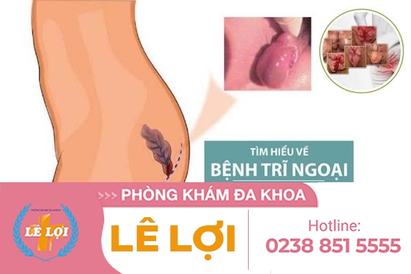 Điều trị trĩ ngoại – Địa chỉ uy tín