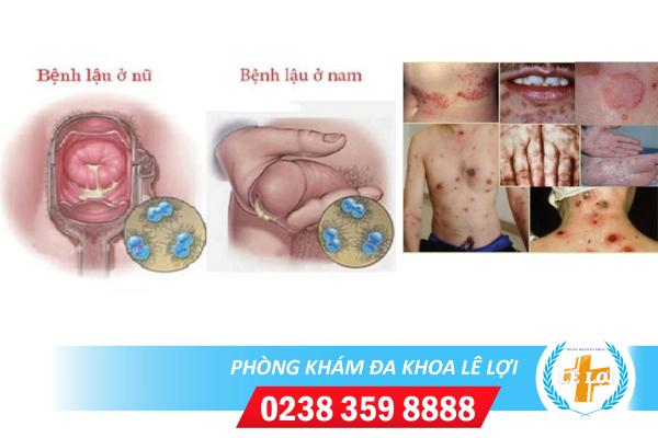 Sự khác biệt giữa bệnh lậu và giang mai