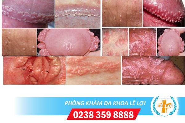 Dấu hiệu nhận biết bệnh sùi mào gà ở vùng kín
