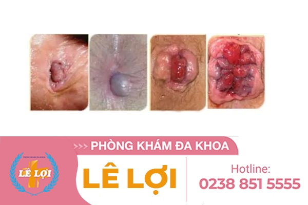 Các phương pháp điều trị sa búi trĩ