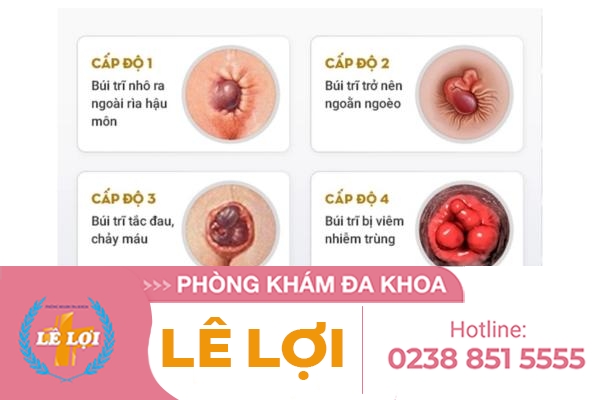 sa-bui-tri-trieu-chung