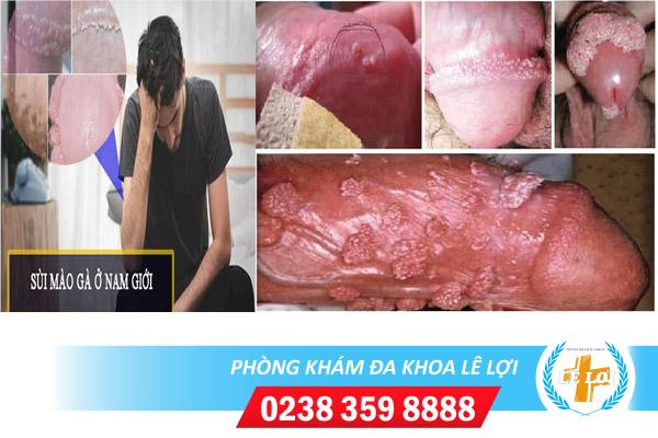 Sùi mào gà vùng kín nam dấu hiệu và cách chữa trị