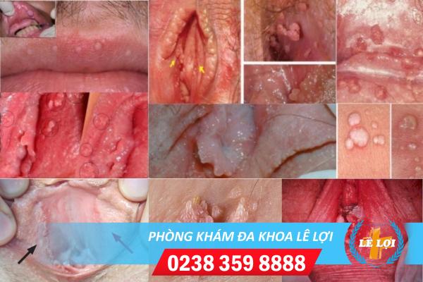 Bác sĩ tư vấn bệnh sùi mào gà online miễn phí và chính xác