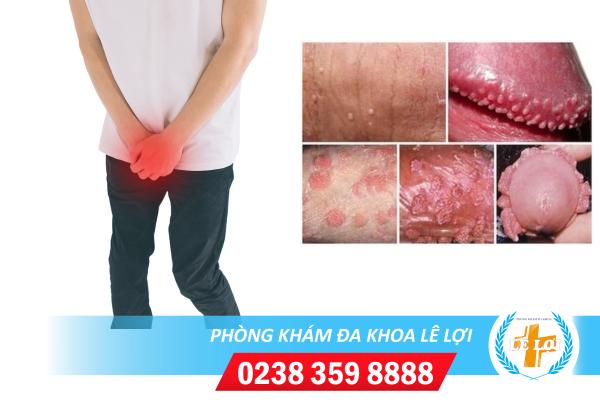 Sùi mào gà vùng kín nam dấu hiệu và cách chữa trị