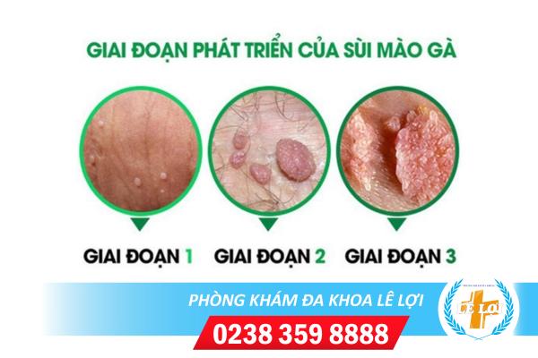 Nguyên nhân sùi mào gà