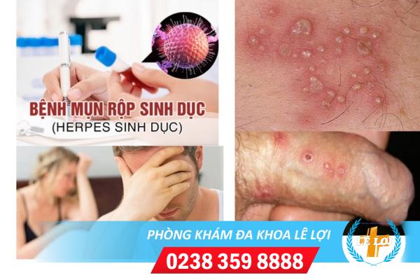 Nổi mụn nước dương vật và cách điều trị
