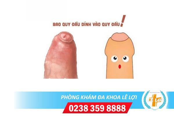 Dính bao quy đầu có nguy hiểm không?