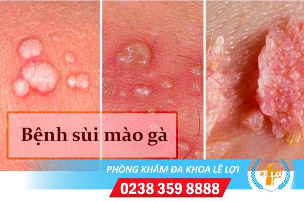 Tác hại bệnh sùi mào gà là gì?