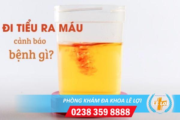 Đái ra máu – Cẩn thận với những bệnh lý nguy hiểm