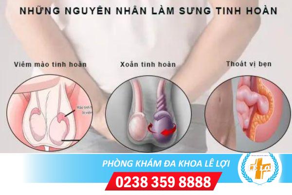 Hiện tượng sưng tinh hoàn và các kiến thức cần biết