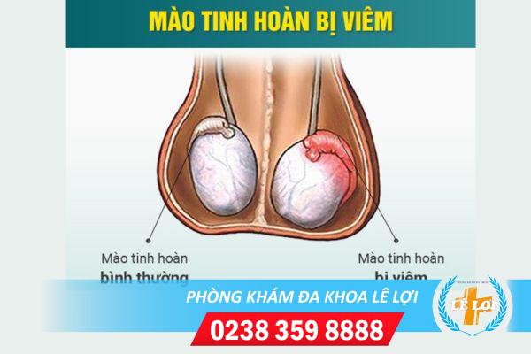 ho-tro-dieu-tri-viem-mao-tinh-hoan-nhu-the-nao-hieu-qua-5