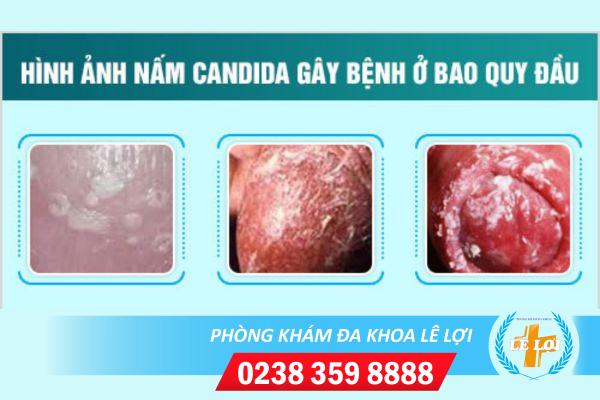 Nguyên nhân nấm bao quy đầu và cách  khắc phục