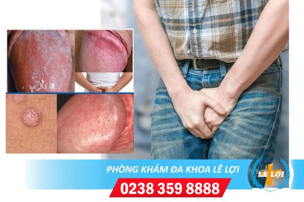 Bệnh nấm ở nam giới và cách hỗ trợ điều trị kịp thời