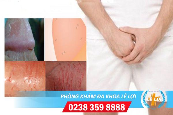 nut-da-quy-dau-do-dau-dau-hieu-va-phuong-phap-ho-tro-dieu-tri-1