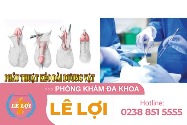 phau-thuat-keo-dai-duong-vat-bang-cach-nao