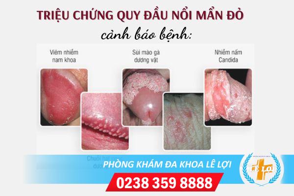 quy-dau-noi-man-do-dau-hieu-cua-nhieu-benh-nguy-hiem (2)