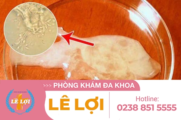Tinh trùng vón cục ở nam giới là như thế nào ?
