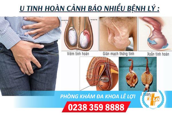 u-tinh-hoan-can-benh-ma-nam-gioi-can-phai-de-phong-1