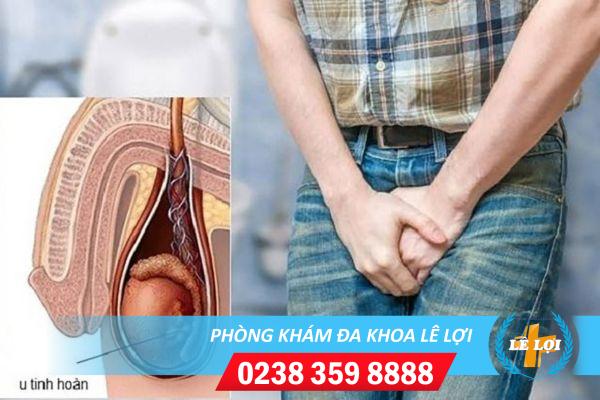 U tinh hoàn – Căn bệnh mà nam giới cần phải đề phòng