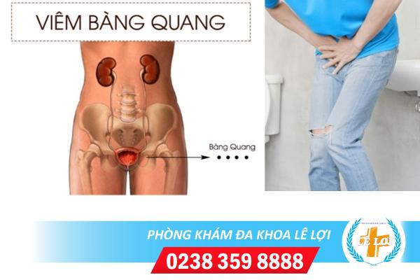 Bệnh viêm bàng quang và những kiến thức cần biết