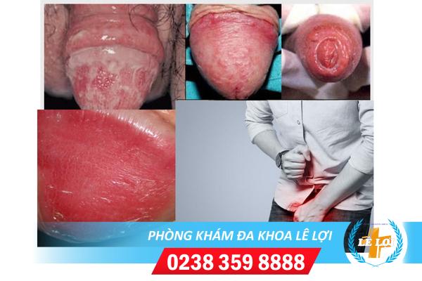 Viêm dương vật – Một trong những triệu chứng nam khoa đáng sợ