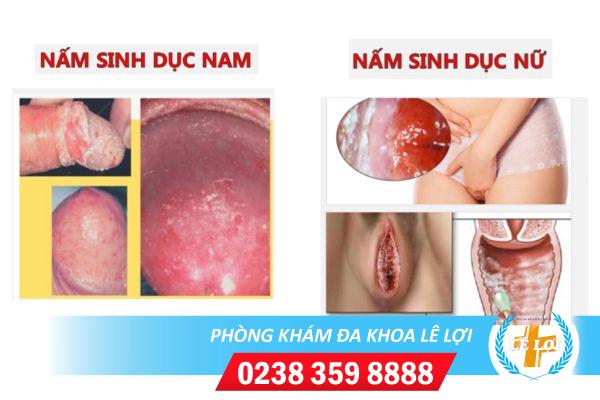 cach-chua-nam-o-bo-phan-sinh-duc-hieu-qua