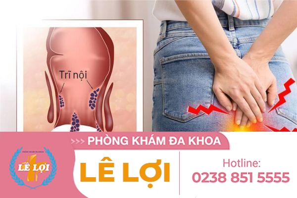 Bệnh trĩ nội là gì? Cách phát hiện sớm bệnh trĩ nội