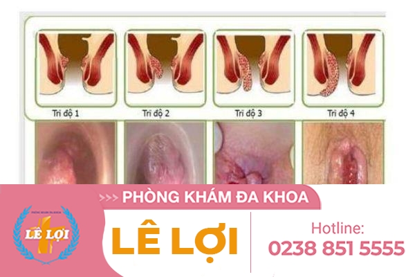 cach-dieu-tri-tri-noi-hieu-qua-dia-chi-uy-tin