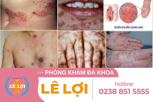 Bệnh giang mai là gì nhận biết như thế nào?