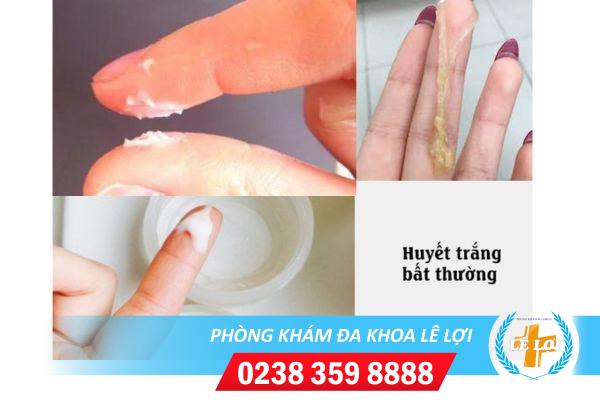 Bệnh huyết trắng là bệnh gì dấu hiệu nhận biết