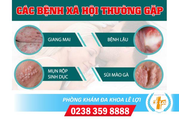cach-chua-tri-benh-xa-hoi-an-toan-hieu-qua-1